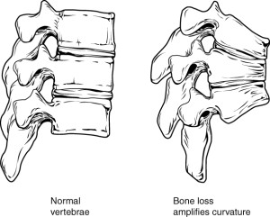 vertebrae of someone with Anorexia and Osteoporosis