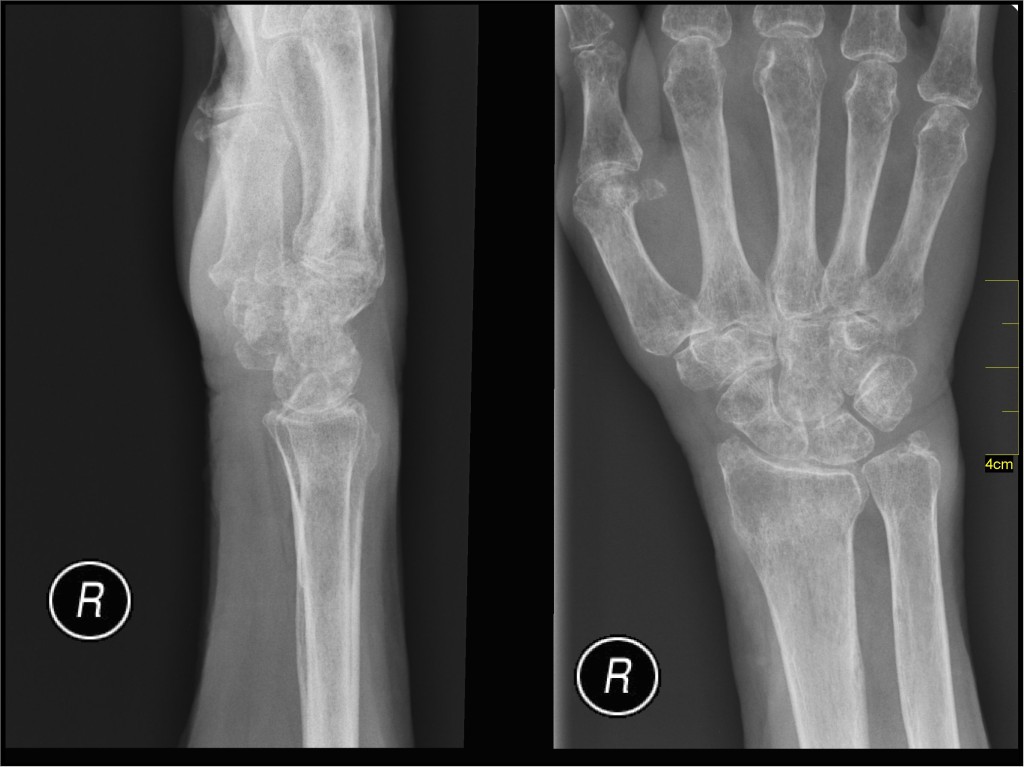 X-ray of bones and Bone Health in Girls