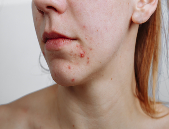 Acne Caused by Anorexia